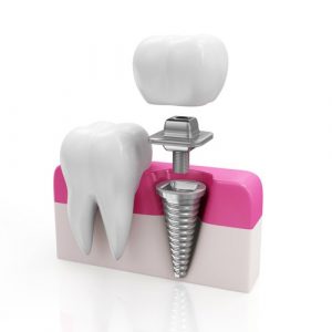 'dental implant'