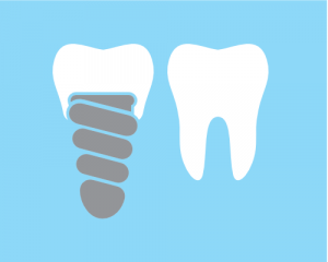 'dental implant and tooth'
