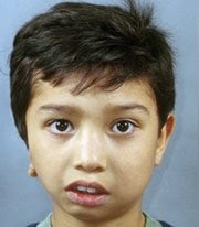 Before Distraction Osteogenesis by Oral Surgeons in North Dakota