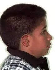 After Distraction Osteogenesis by Oral Surgeons in North Dakota