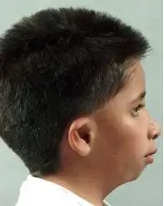 Before Distraction Osteogenesis by Oral Surgeons in North Dakota