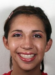 After Distraction Osteogenesis by Oral Surgeons in North Dakota