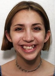 Before Distraction Osteogenesis by Oral Surgeons in North Dakota