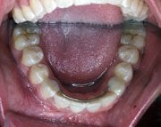 After Distraction Osteogenesis by Oral Surgeon in North Dakota