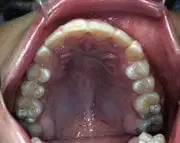 After Distraction Osteogenesis by Oral Surgeon in North Dakota