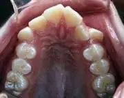 Before Distraction Osteogenesis by Oral Surgeons in North Dakota