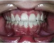 After Distraction Osteogenesis by Oral Surgeon in North Dakota