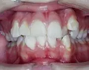 Before Distraction Osteogenesis by Oral Surgeon in North Dakota