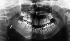 Digital Radiograph after Distraction Osteogenesis by Oral Surgeon in North Dakota