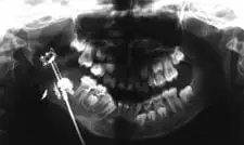Digital Radiograph before Distraction Osteogenesis by Oral Surgeon in North Dakota
