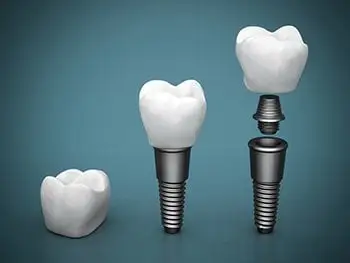A visual representation of the different parts of an implant