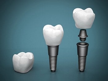 A visual representation of the different parts of an implant