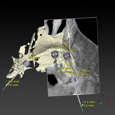3-D image showing thickness of the alveolar bone and best areas for implant placements.