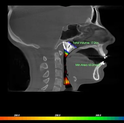 X-ray image showing patients airway
